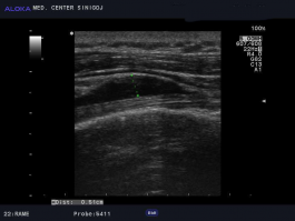 Ultrazvok rame - peritendinitis tetive m. biceps brachii 2